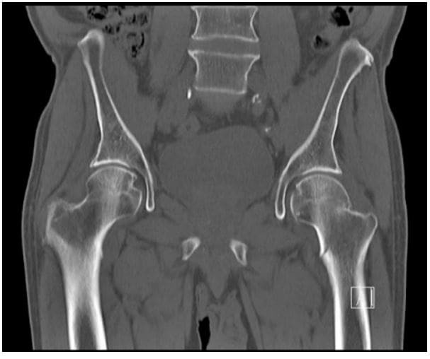 снимок компьютерная томография тазобедренного сустава